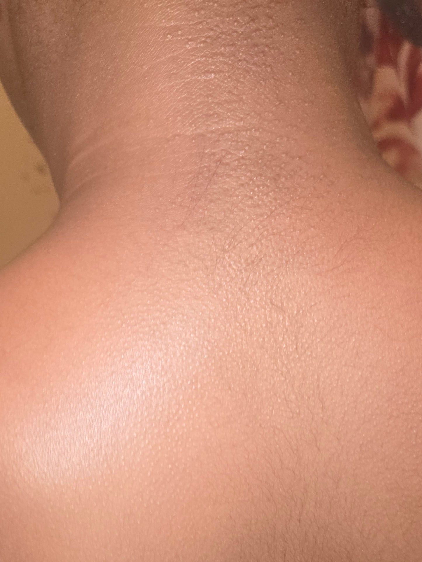 Eczema/ Acne Sensitive skin Body butter